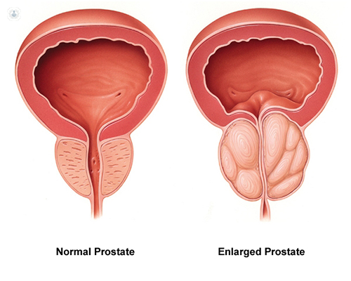 prostate cancer